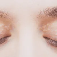 matia_xanthelasma