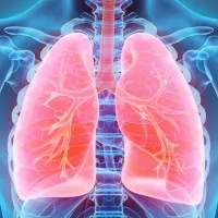 pneumonia