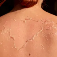 derma