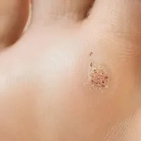 mirmigia