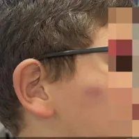 Ξυλοκόπησαν 11χρονο μαθητή στο προαύλιο του σχολείου τους