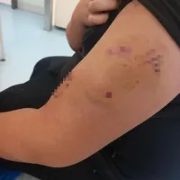 Τραύματα στο χέρι παιδιού από επίθεση σκύλου