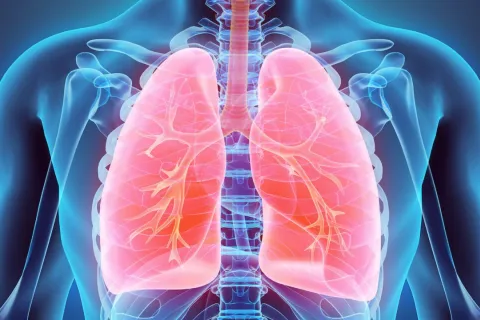 pneumonia