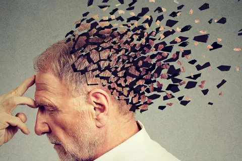 alzheimer