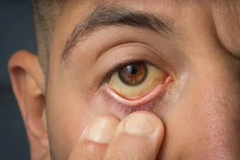yellow eyes